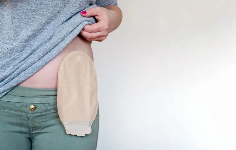 What Supplies Do You Need for a Colostomy? Know Your Options