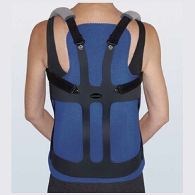 Thoracic Lumbar Sacral Orthosis with Zero Degree Lordosis Curve