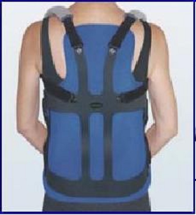 Thoracic Lumbar Sacral Orthosis with Zero Degree Lordosis Curve
