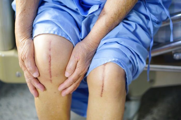 Top 5 Mistakes After Knee Replacement [WITH VIDEO]